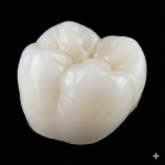 Estetica Final - Corona de Zirconia